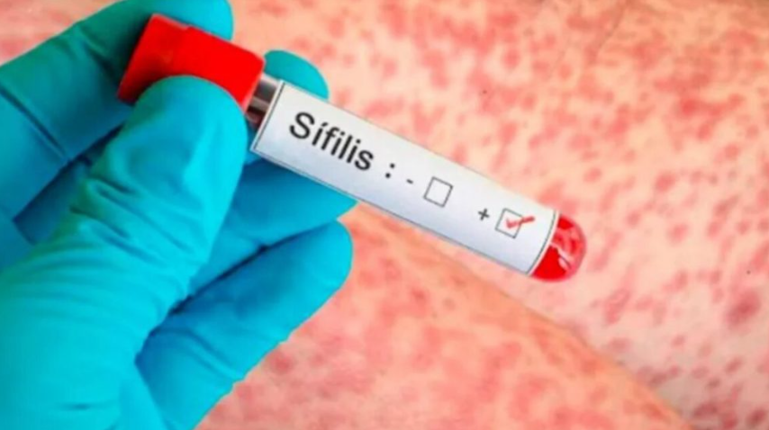 En 2025 se registró un fuerte aumento en los casos de sífilis
