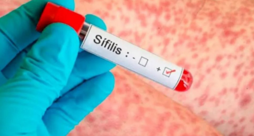 En 2025 se registró un fuerte aumento en los casos de sífilis