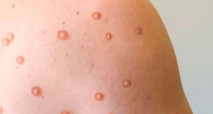 Detectaron el primer caso de viruela del Mono en Argentina
