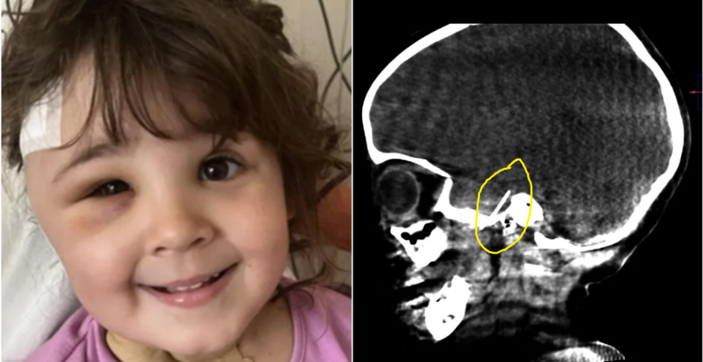 "Ha sido un milagro": extraen una aguja del cerebro de una niña