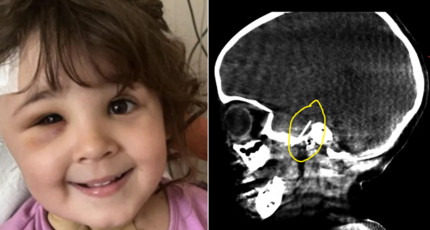 "Ha sido un milagro": extraen una aguja del cerebro de una niña