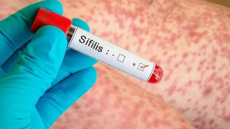 Alerta sanitaria por s&iacute;filis: en 2025 se registraron m&aacute;s de 46 mil casos 