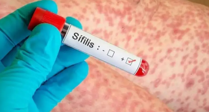 Alerta sanitaria por s&iacute;filis: en 2025 se registraron m&aacute;s de 46 mil casos 