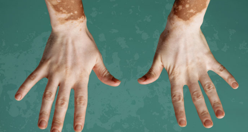 D&iacute;a Mundial del Vitiligo: qu&eacute; es, diagn&oacute;stico y tratamiento