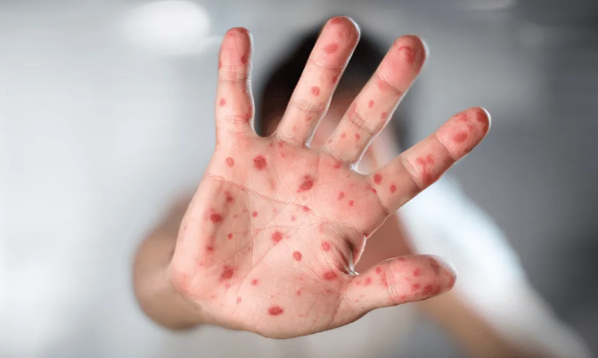 Viruela del Mono: los casos de Mpox se mantienen estables en el pa&iacute;s