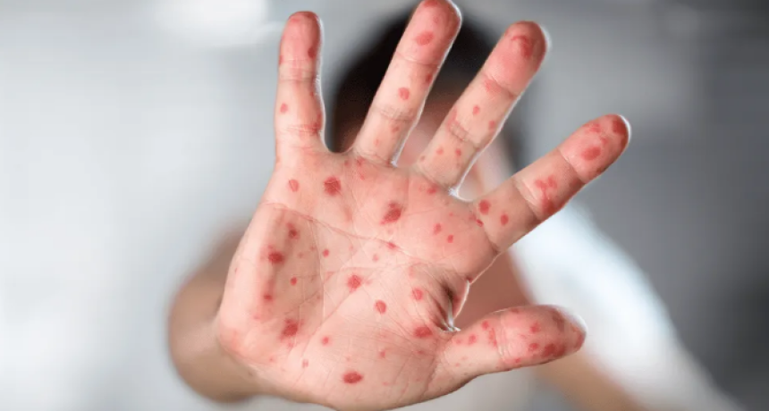 Viruela del Mono: los casos de Mpox se mantienen estables en el pa&iacute;s