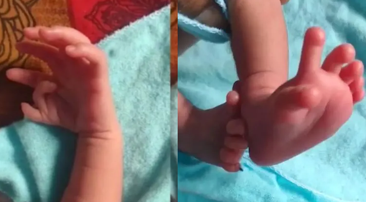 Una beba nació con 26 dedos: 