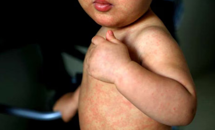 Salud emitió un alerta por la circulación de viajeros con sarampión en varias provincias