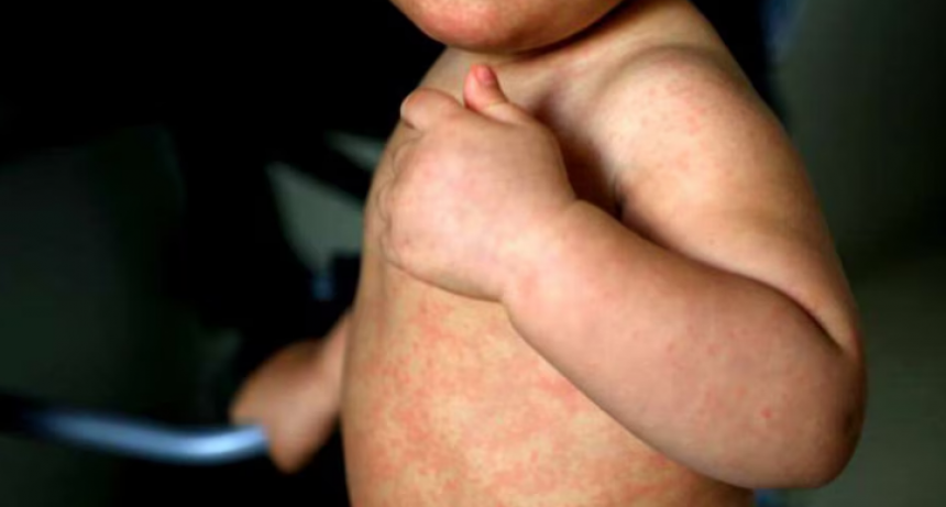 Salud emitió un alerta por la circulación de viajeros con sarampión en varias provincias