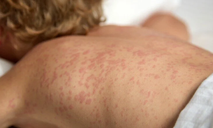 Gobierno chileno emite alerta epidemiológica por alza de sarampión en Argentina y destaca la vacunación